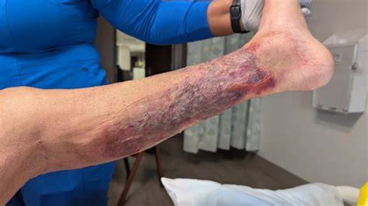 Follow up for flesh eating bacteria. Dear community thanks for your