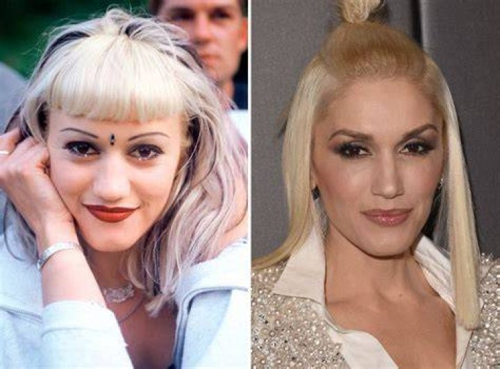 Gwen Stefani Before And After Braces