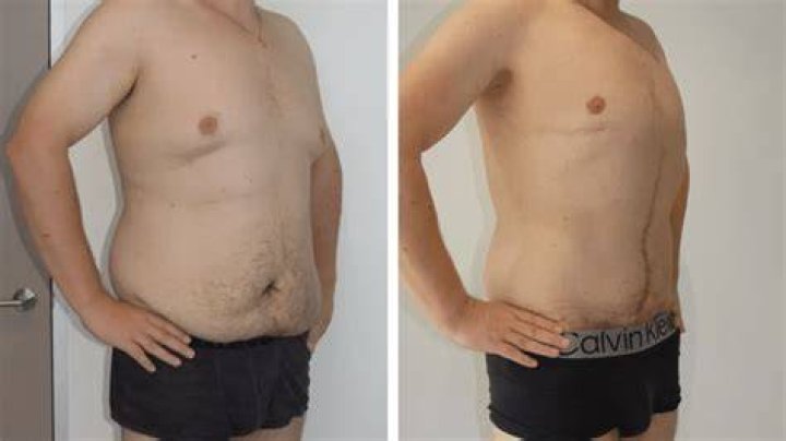 Since having skin removal surgery, Julie says she finally feels good about herself