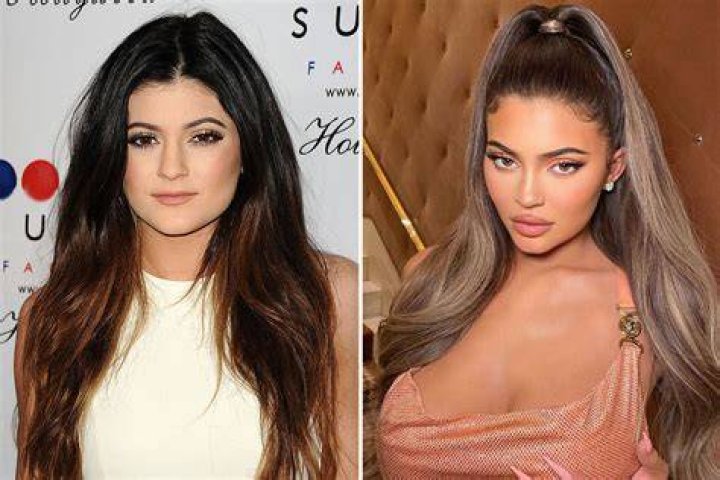 What did Kylie Jenner look like before and after lip filler? The US Sun