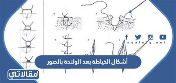 الخياطة التجميلية بعد الولادة بالصور