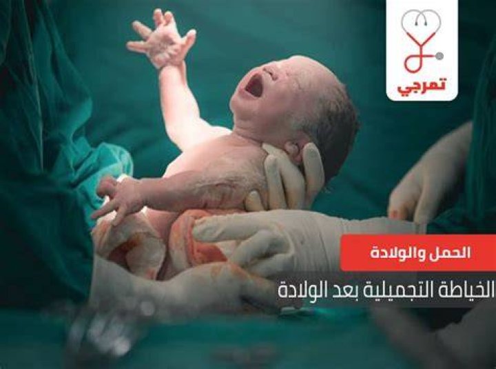 الخياطة التجميلية بعد الولادة